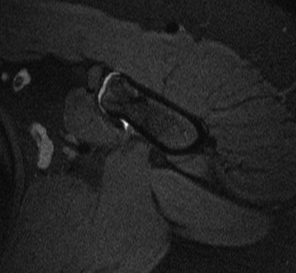 Figure 2 for case osteochondroma ( RID4136 )